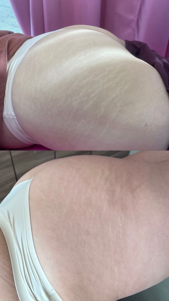 antes y despues micropuntura