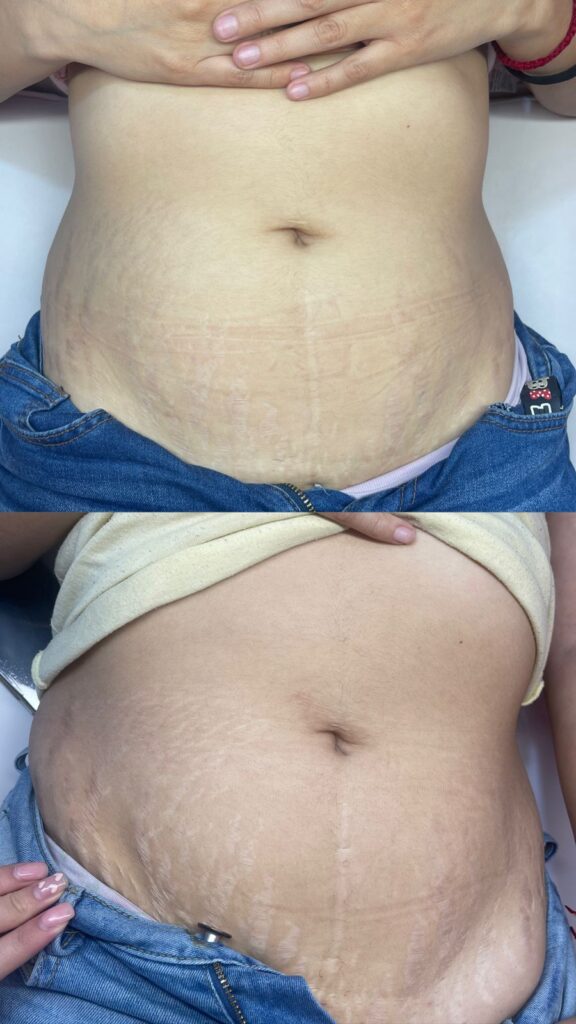 micropuntura brasileña