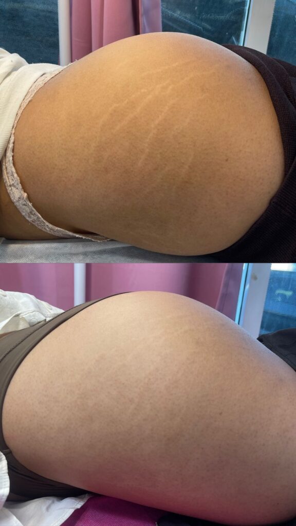 eliminacion de estrias en gluteos