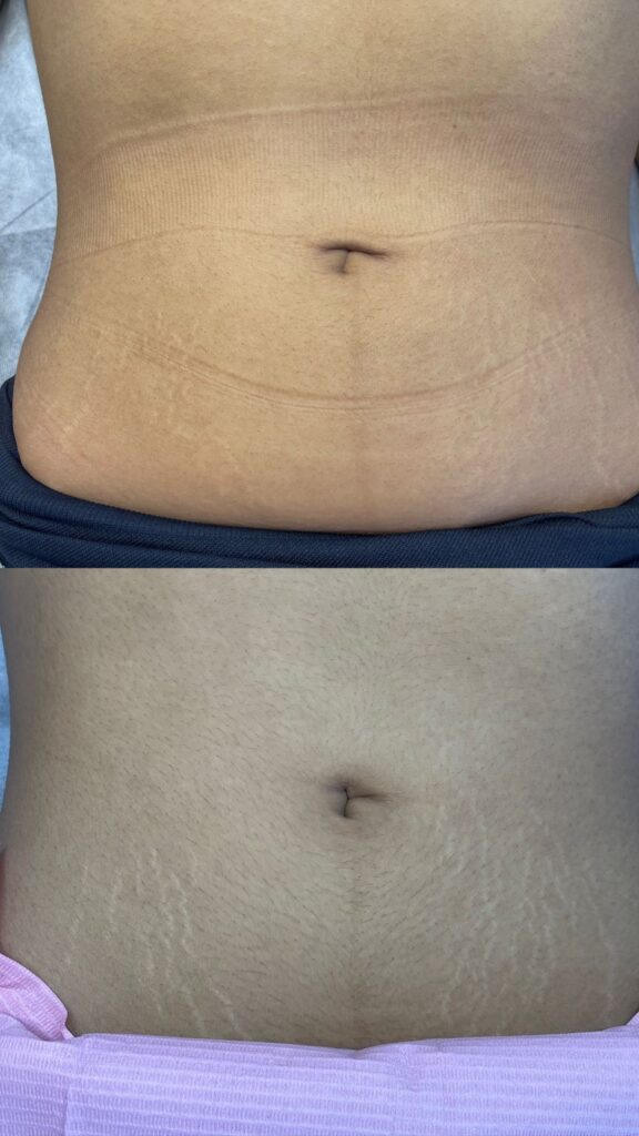 testimonio eliminacion de estrias