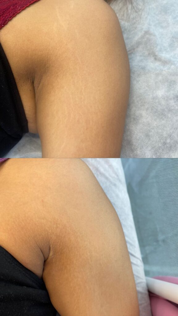 micropuntura estrias