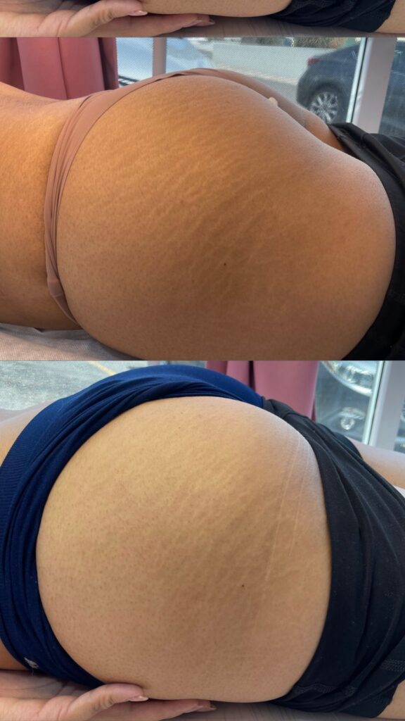 eliminacion de estrias